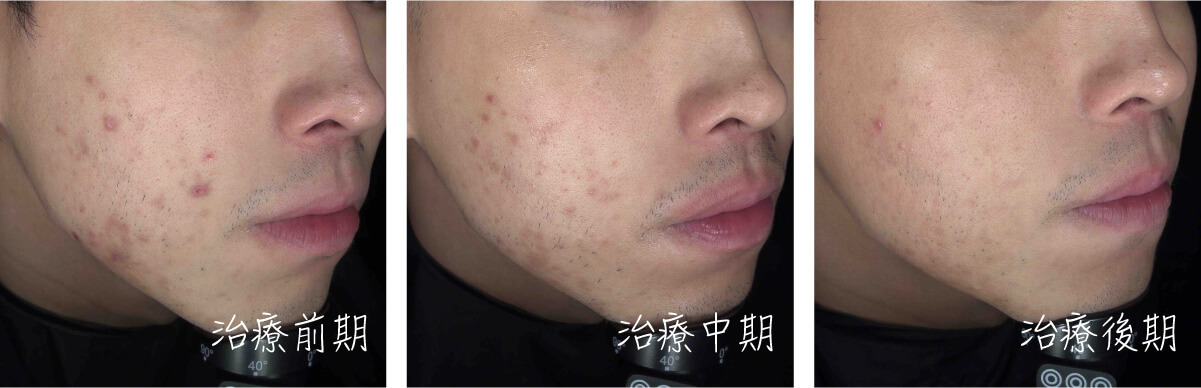 染料雷射案例