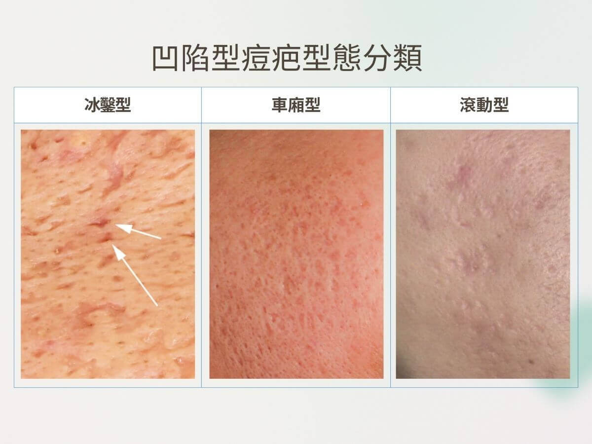 凹陷型痘疤型態分類