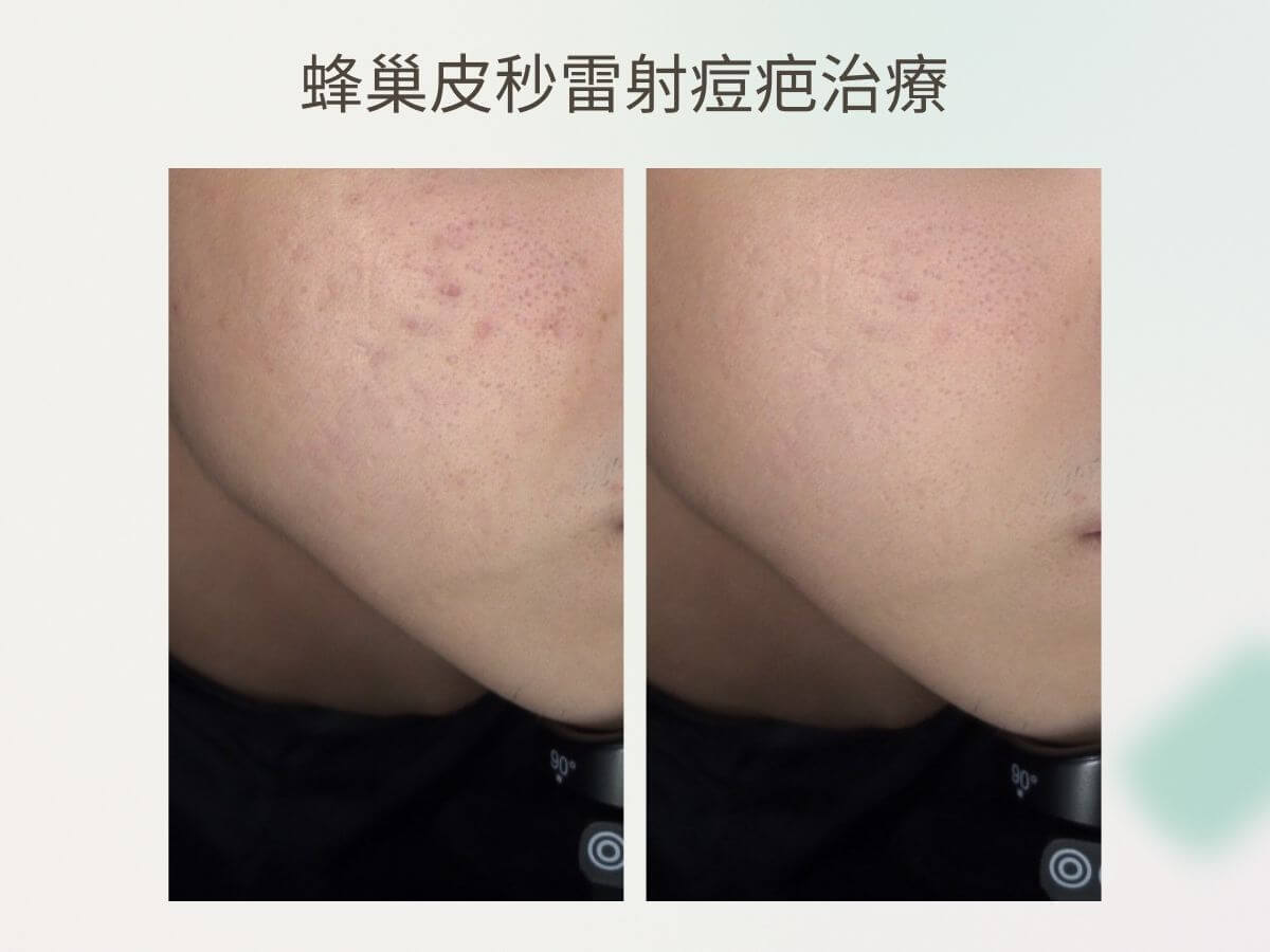蜂巢皮秒雷射痘疤治療
