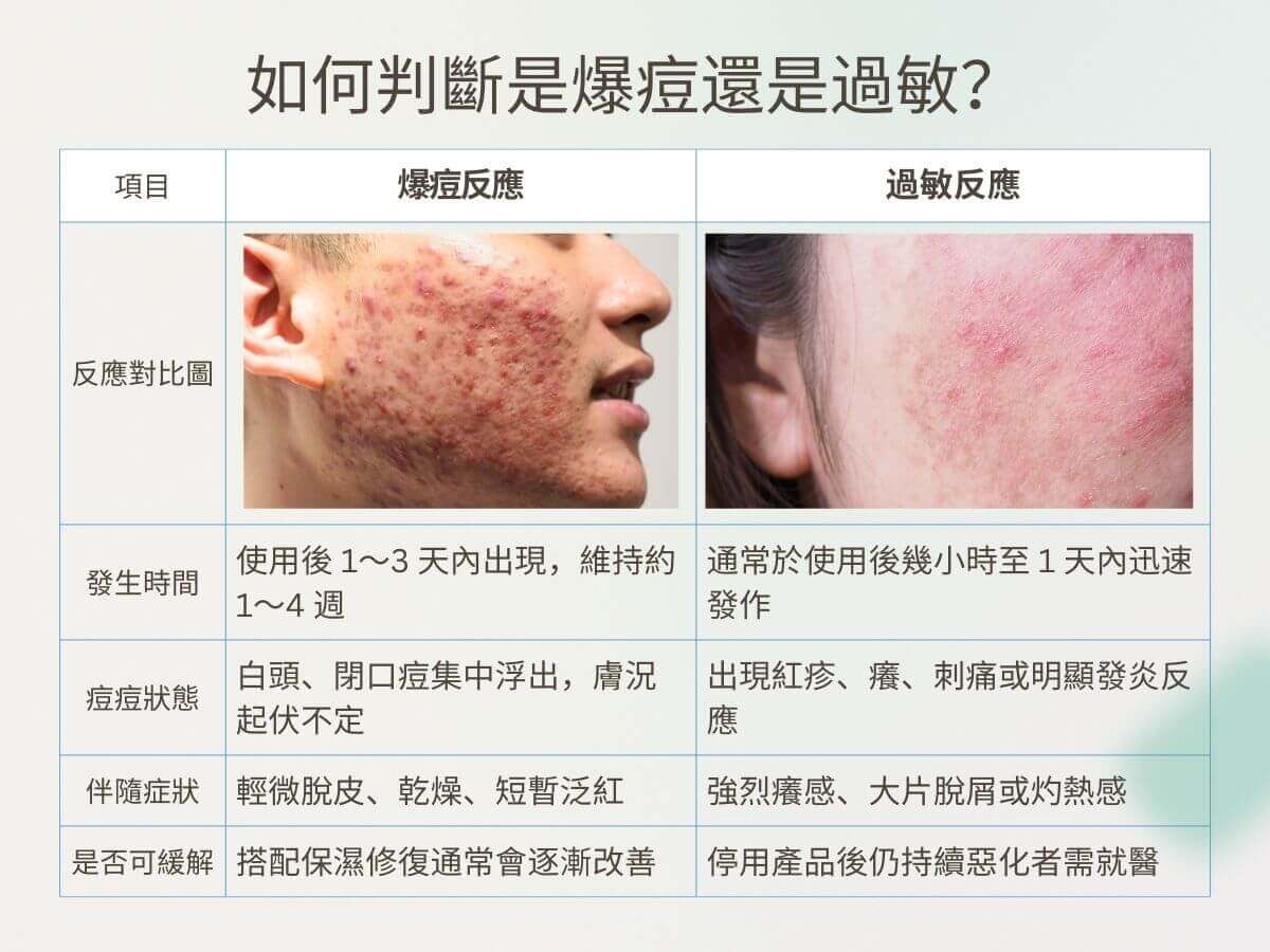 如何判斷是爆痘還是過敏？ 爆痘期 vs. 過敏反應對比圖 項目 爆痘反應 過敏反應 發生時間 使用後 1～3 天內出現，維持約 1～4 週 通常於使用後幾小時至 1 天內迅速發作 痘痘狀態 白頭、閉口痘集中浮出，膚況起伏不定 出現紅疹、癢、刺痛或明顯發炎反應 伴隨症狀 輕微脫皮、乾燥、短暫泛紅 強烈癢感、大片脫屑或灼熱感 是否可緩解 搭配保濕修復通常會逐漸改善 停用產品後仍持續惡化者需就醫