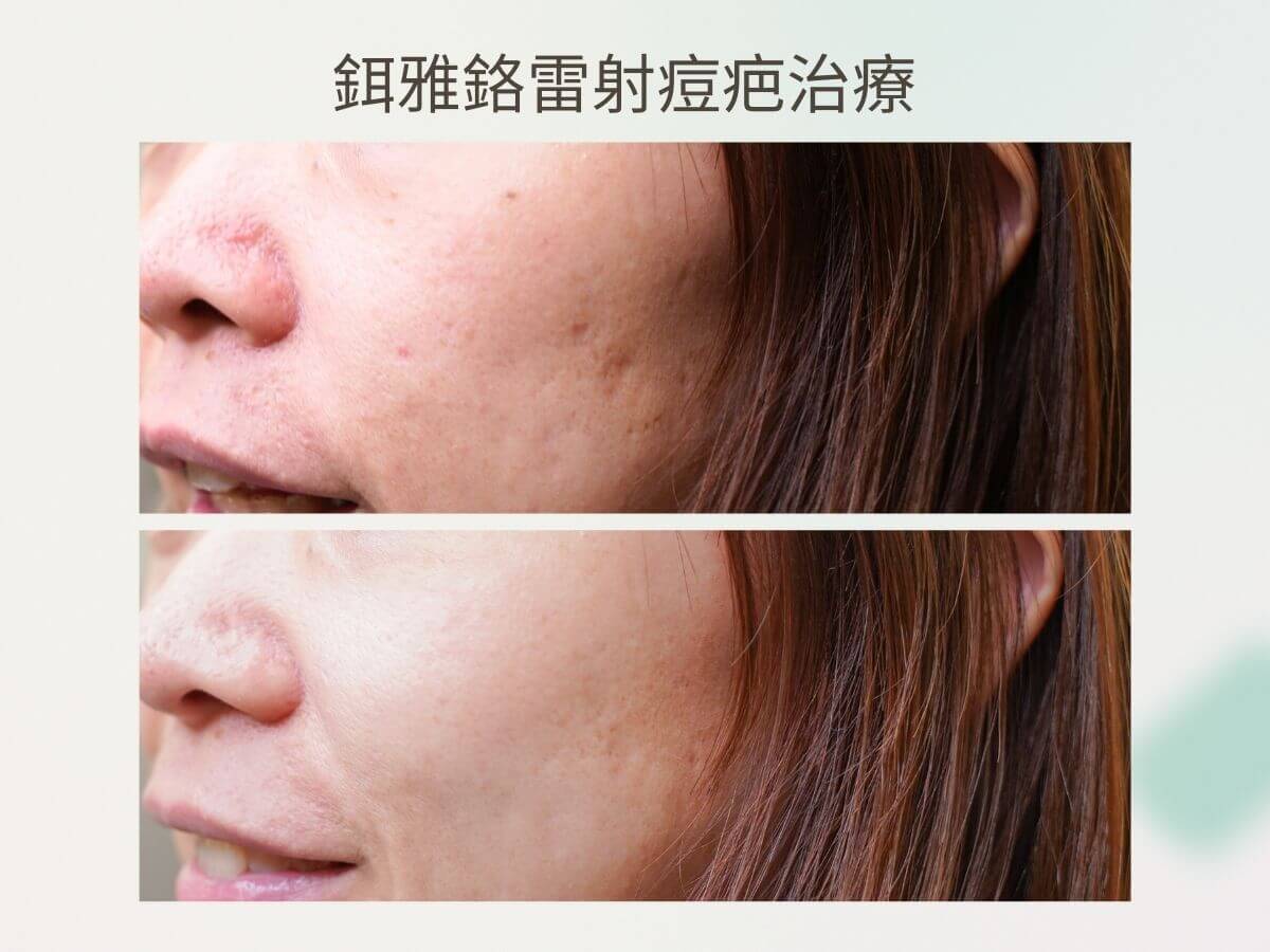 鉺雅鉻雷射痘疤治療案例 鉺雅鉻雷射是什麼