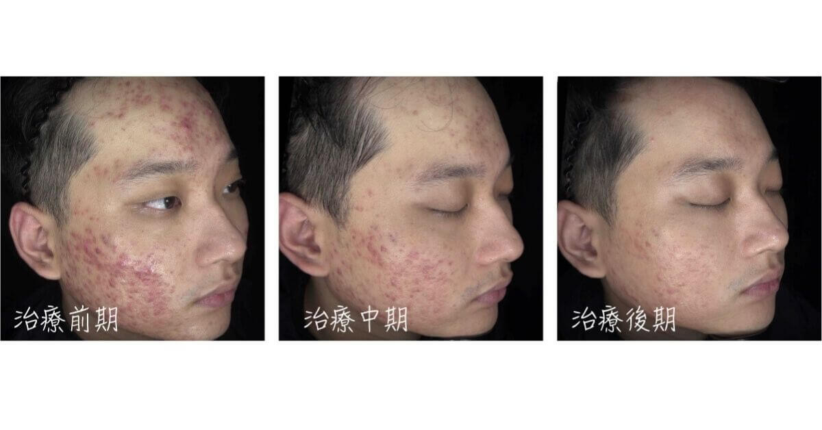 青春痘疤泛紅治療 染料雷射