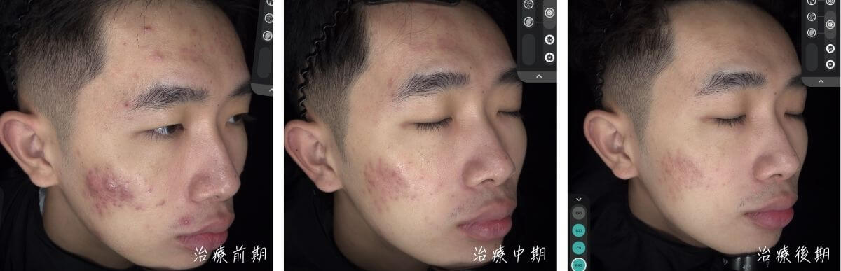 青春痘治療歷程2ep34