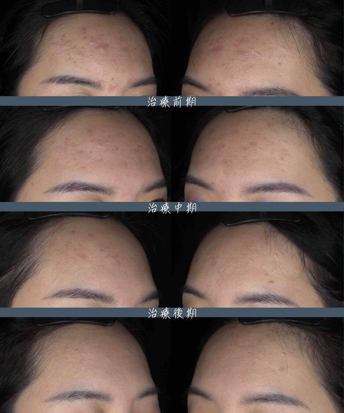 青春痘治療歷程ep31